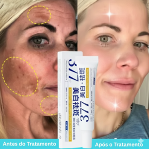 Creme Clareador 377 – Redução de Manchas e Melasma, Uniformização e Luminosidade da Pele